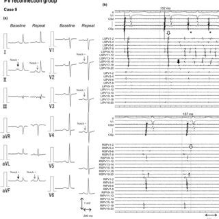 Changes in P‐wave morphology on the electrocardiogram following ...