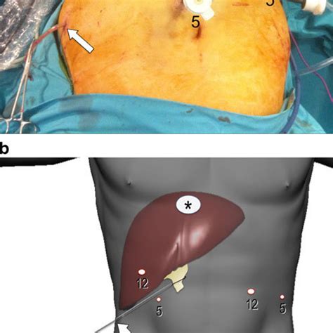 A Patient And Trocar Position For Laparoscopic Resection Of Lesions