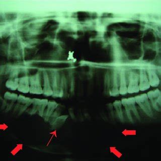 Orthopantomograph Demonstrating A Solitary Well Defined Radiolucency