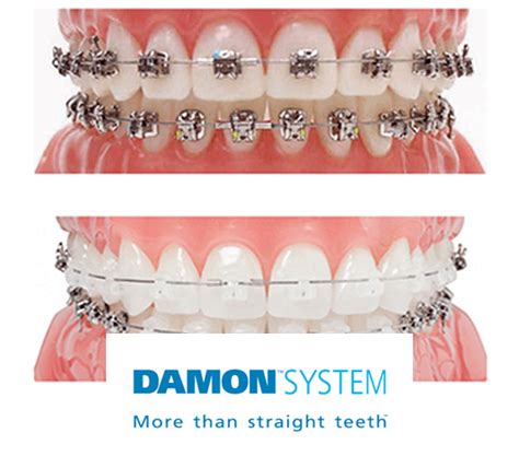 Braces Derby Invisalign Invisible Clear Braces Damon Incognito