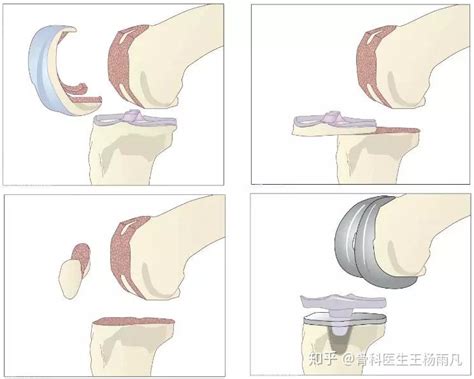 膝关节置换术示意图及部分手术风险解读 知乎