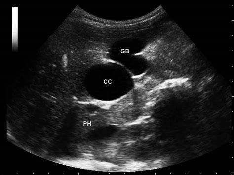 Choledochal Cyst Types Causes Symptoms Diagnosis And Treatment