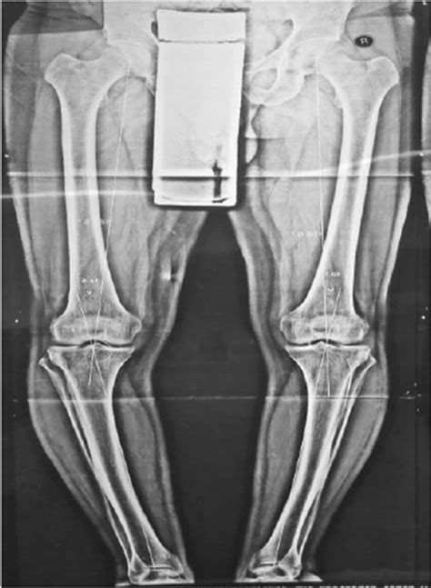 Preoperative Anteroposterior Radiography Showing The Severe Varus Download Scientific Diagram