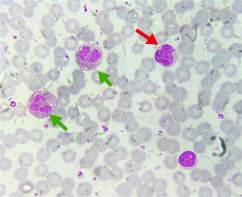 Peripheral blood smear showing leucocytosis with atypical lymphocyte ...