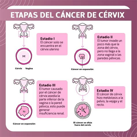 Cáncer De Cérvix Información Para Pacientes