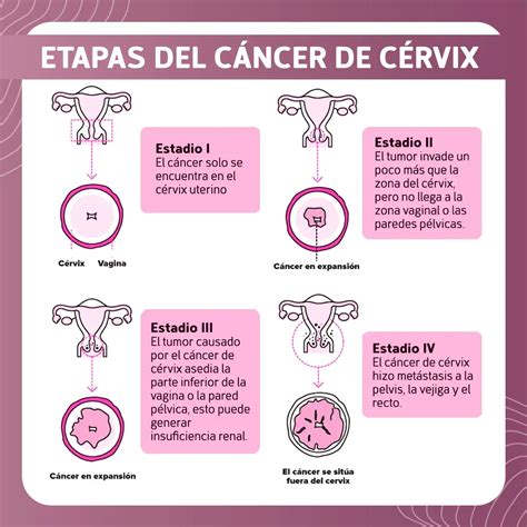 Cáncer de cérvix información para pacientes