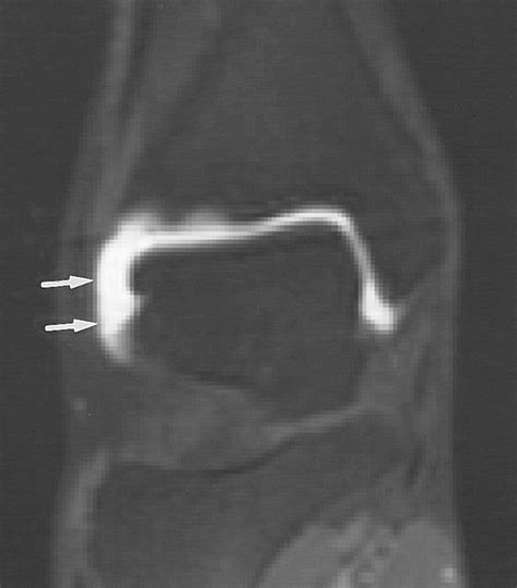 Soft Tissue And Osseous Impingement Syndromes Of The Ankle Role Of