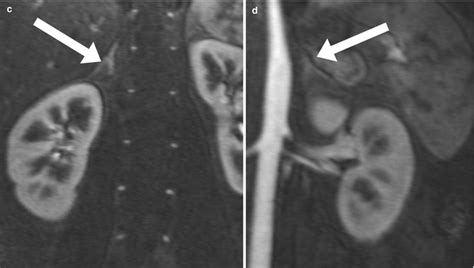 Cross Sectional Imaging Of The Adrenal Gland Radiology Key