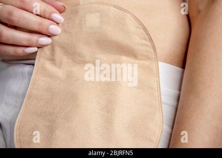 Front View On Colostomy Bag Attached To Man Patient Medical Theme