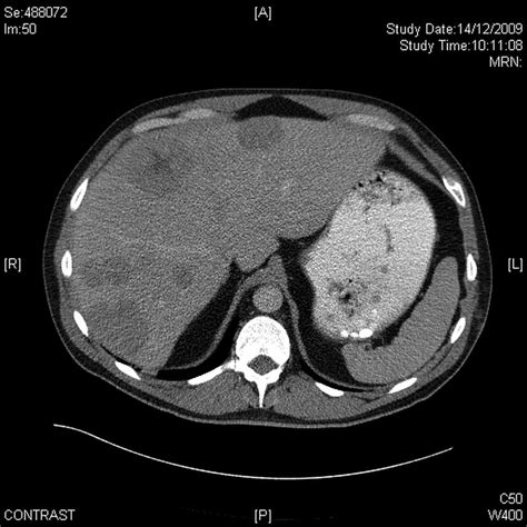 Pancreatic Panniculitis Bmj Case Reports