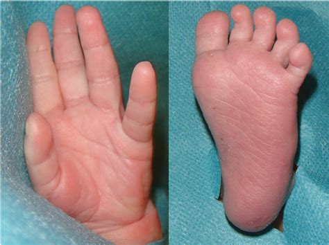 Palmar And Plantar Surfaces Of A Newborn They Are Formed Very Early In Download Scientific