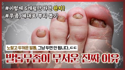 발톱무좀 없애는 방법 최신