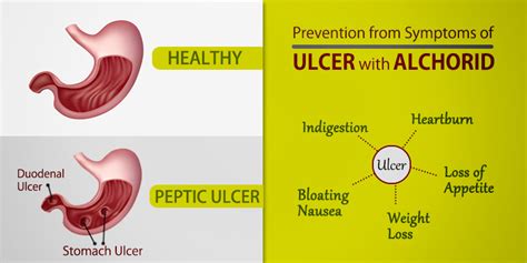 Peptic Ulcer Disease Gastric Duodenal Ulcers Causes 60 Off