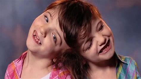 Top 10 Conjoined Twins Fascinating Stories Of Survival And Unity