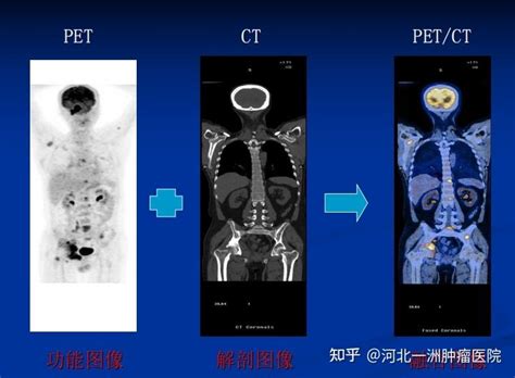 Pet Ct为何被称为“查癌神器”？做这个检查有什么用？检查前有哪些注意事项？ 知乎