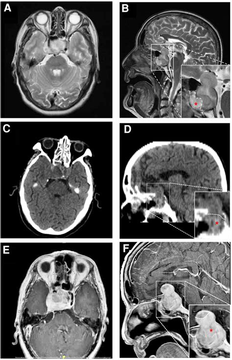 Mri A B E F And Ct C D Findings In A Patient With Pituitary Adenoma