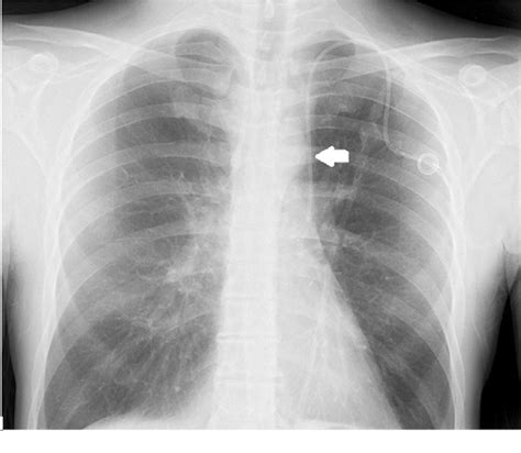 Figure 1 From Persistent Left Superior Vena Cava Associated With Right Aberrant Subclavian