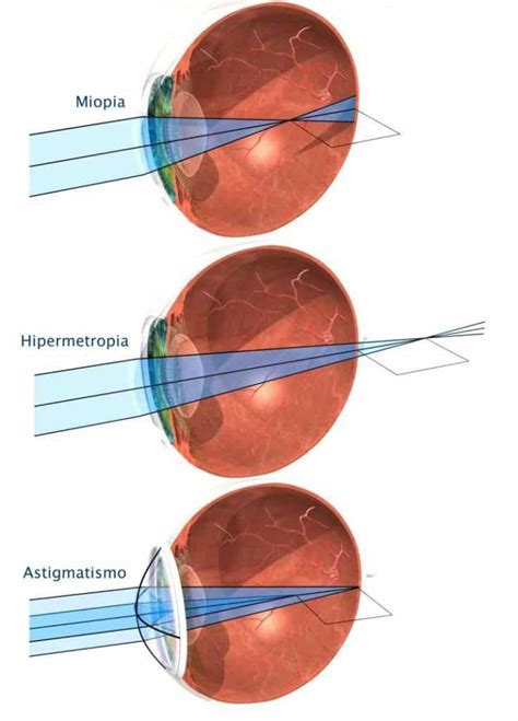 Miopía hipermetropía y astigmatismo Área Oftalmológica Avanzada