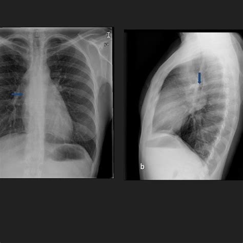 Felson S Classification Of Mediastinum In Anterior Middle And Download Scientific Diagram