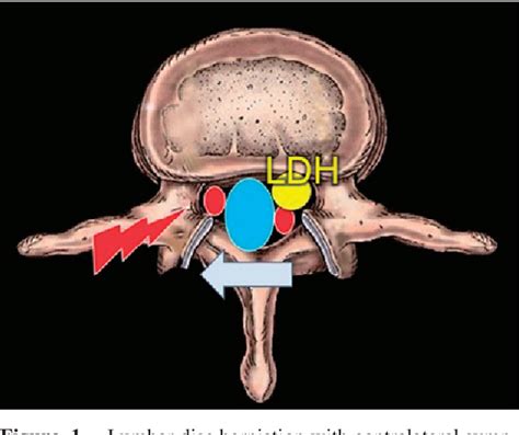 Figure 1 From Radiculopathy Contralateral To The Side Of Disc