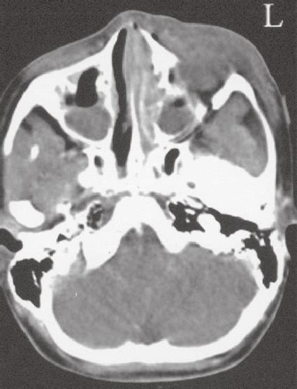 Axial Ct Image Shows Left Sided Maxillary Sinusitis With Osteomyelitis