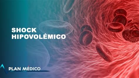 El Shock Hipovolémico Y Sus Diferentes Tipos Plan Médico