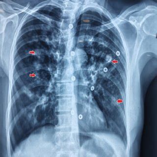 X Ray Chest Posterior Anterior View Showing Multifocal Infiltrates