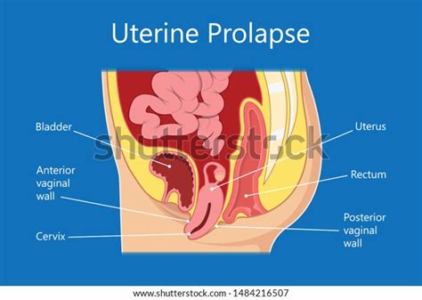 Pelvic Floor Prolapse Type Uterine Uterus Stock Vector Royalty Free 1484216507