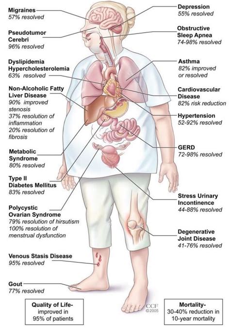 The Benefits Of Bariatric Surgery Ask The Nurse Expert