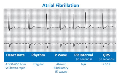 Arrhythmia Recognition Part 1 Clinical View