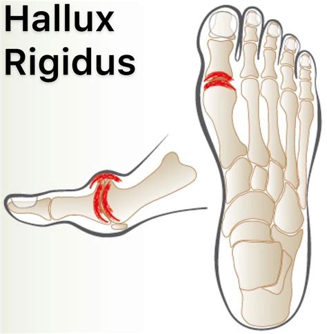 Hallux Rigidus Anatomy