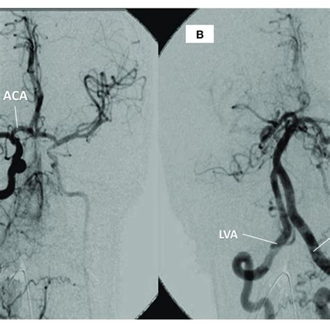 Pdf Takayasu Arteritis