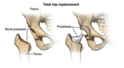 Total Hip Replacement Surgery London Bridge Orthopaedics