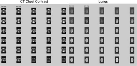 Retrieved Images of CT Chest Contrast and Lungs | Download Scientific ...