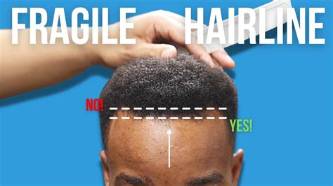 How To Line Up A Fragile Hairline With No Pushback Youtube