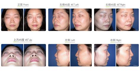 Short Nose (Upturned Nose) Correction | WishClinic