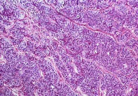 Lm Of Transitional Cell Carcinoma Of Bladder Photograph By Dr E Walker