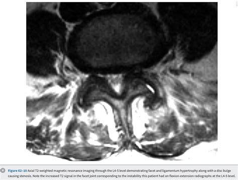 Spinal Stenosis Rygsygdom Dk