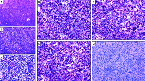 Pathological Examination Of Left Parotid Hande Staining A 100Â