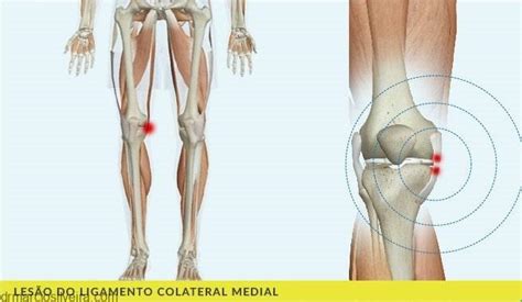 Lesão Do Ligamento Colateral Medial No Joelho E Tratamentos Dr Márcio Silveira