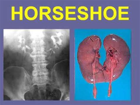 Glomerular Diseases Pathology 1 2 Renal System YouTube