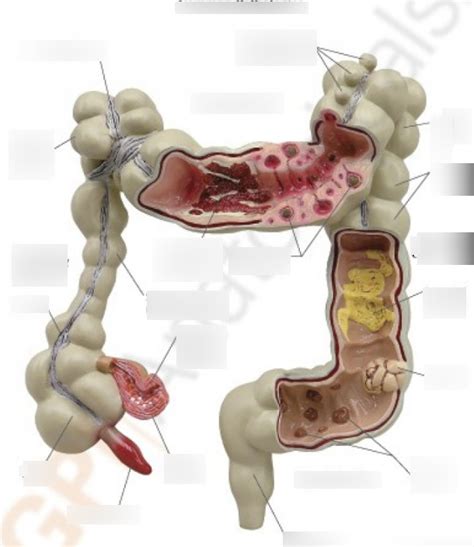 Common Pathologies Of The Large Intestine Diagram Quizlet