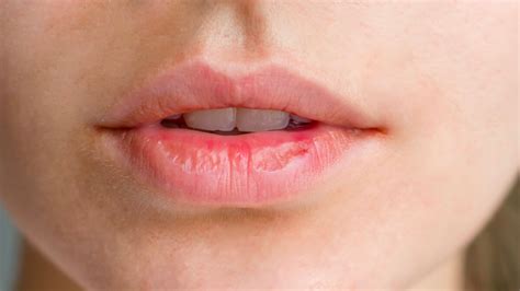 Labios Secos Y Agrietados Estos Son Los Motivos M S Frecuentes