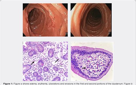 Pdf Eosinophilic Enteritis A Rare Dissease Semantic Scholar