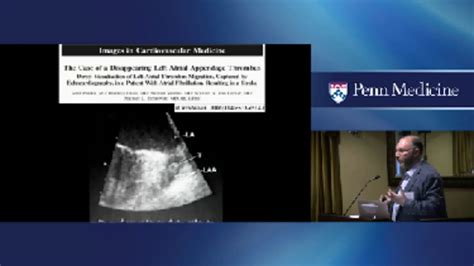 Left Atrial Appendage Occlusion Devices Penn Physician Videolink