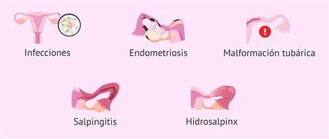 Problemas De Fertilidad Femenina Por Factor Tub Rico