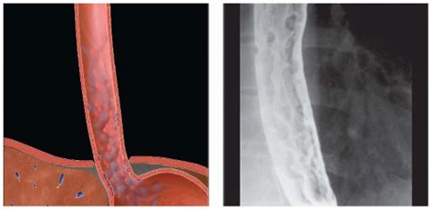 Esophageal And Gastric Varices