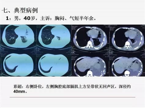 内科胸腔镜技术及应用体会胸膜