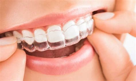 Cl Nica Invisible De Qu Est Hecho Y C Mo Funciona Invisalign