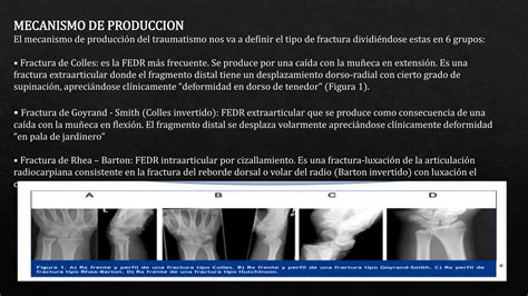 Fracturas Del Radio Distal De Miembro Superior Ppt